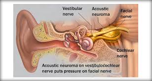 acoustic neuroma mark ruffalo
